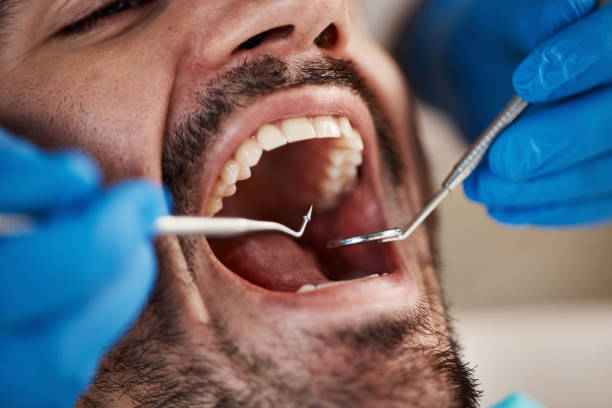 Best Knocked-Out Tooth (Avulsed Tooth) Treatment in Oak Hills, CA